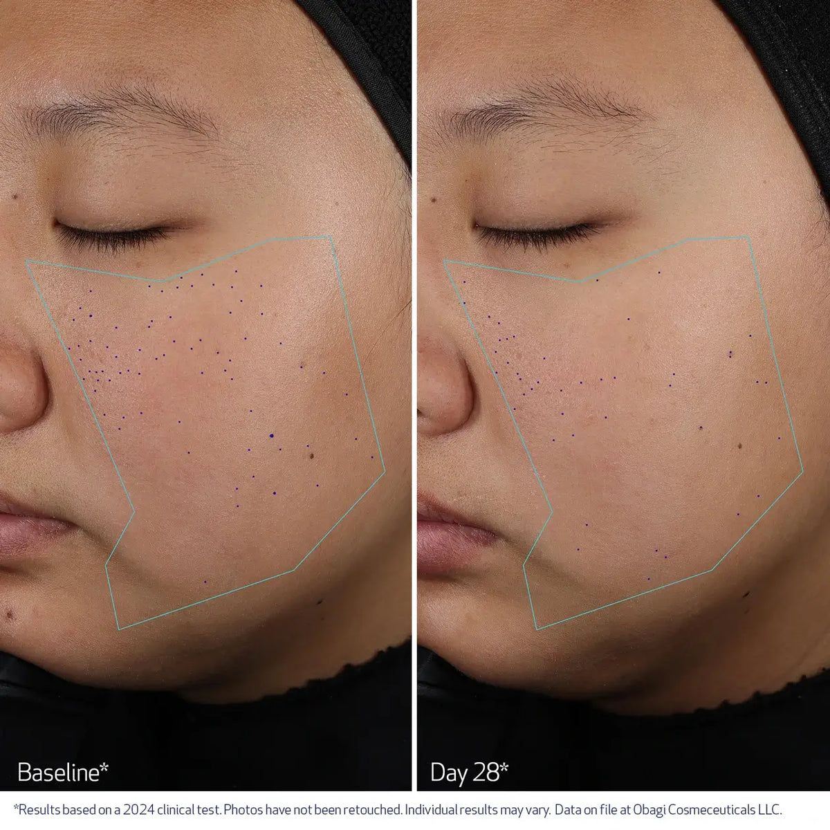 Obagi Clenziderm M.D. Pore Therapy image 5